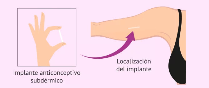 Imagen: Localización del implante anticonceptivo