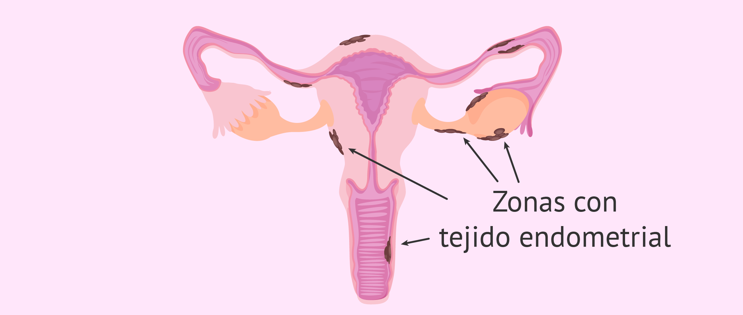 Localización de los implantes endometriales