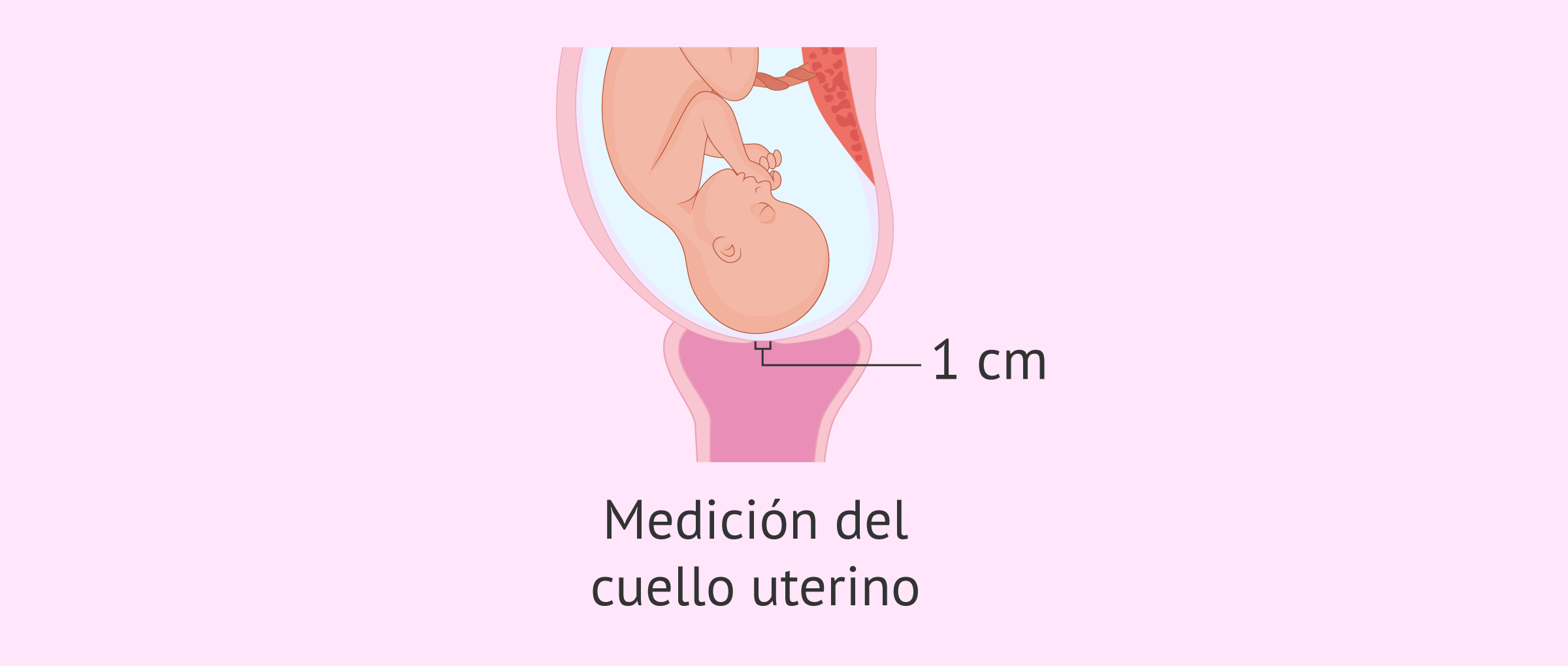 ¿Cuánto mide el cuello uterino en el parto pretérmino?