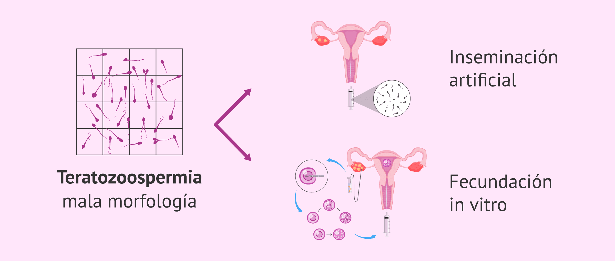 Imagen: Opciones de tratamientos para lograr el embarazo con mala morfología espermática