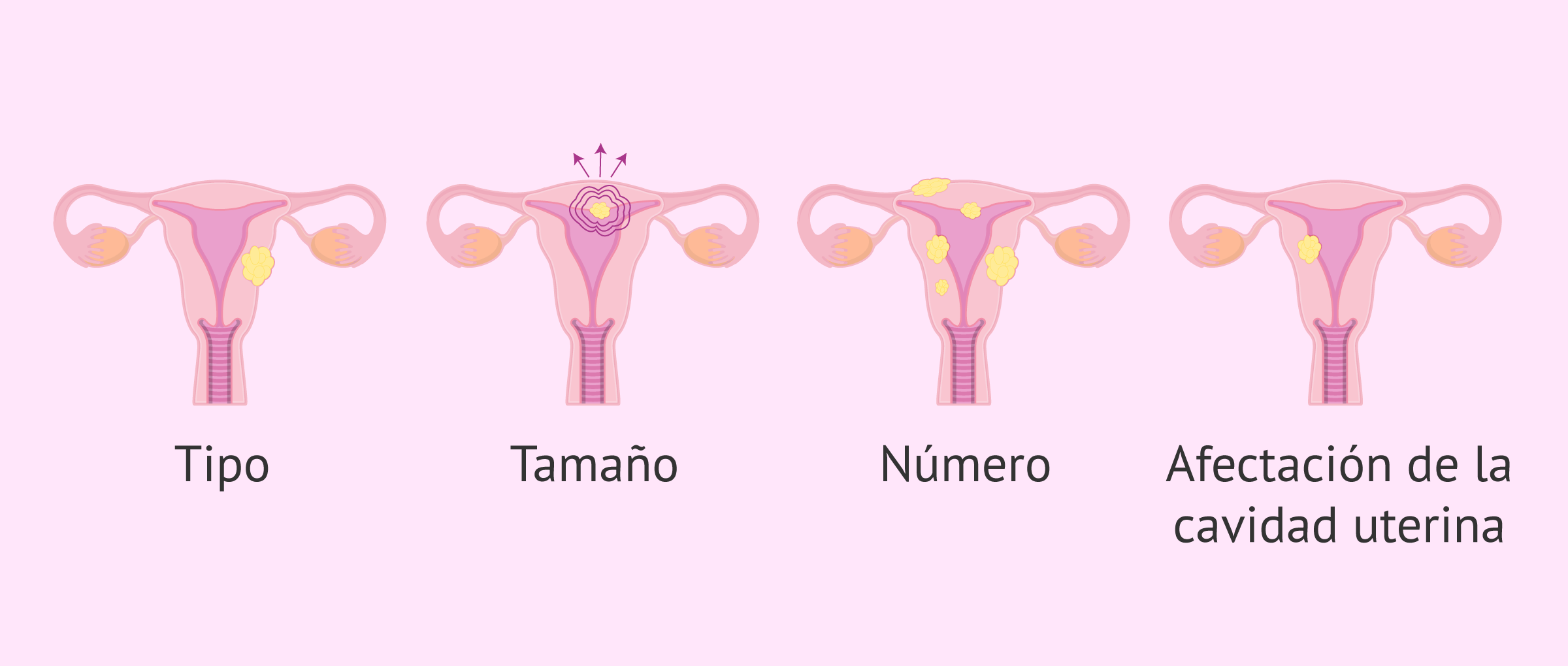 ¿Afectan los miomas uterinos a la FIV?