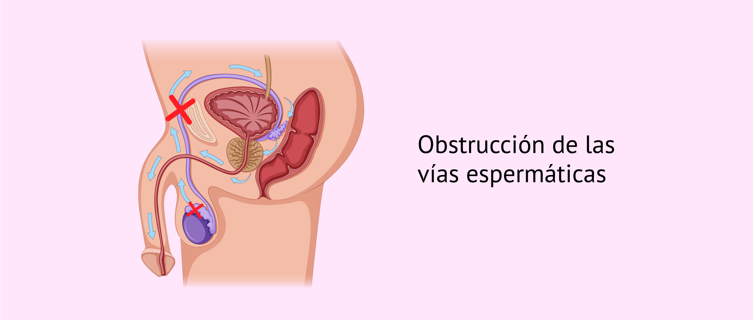 Obstrucción del epidídimo, los conductos deferentes y la uretra