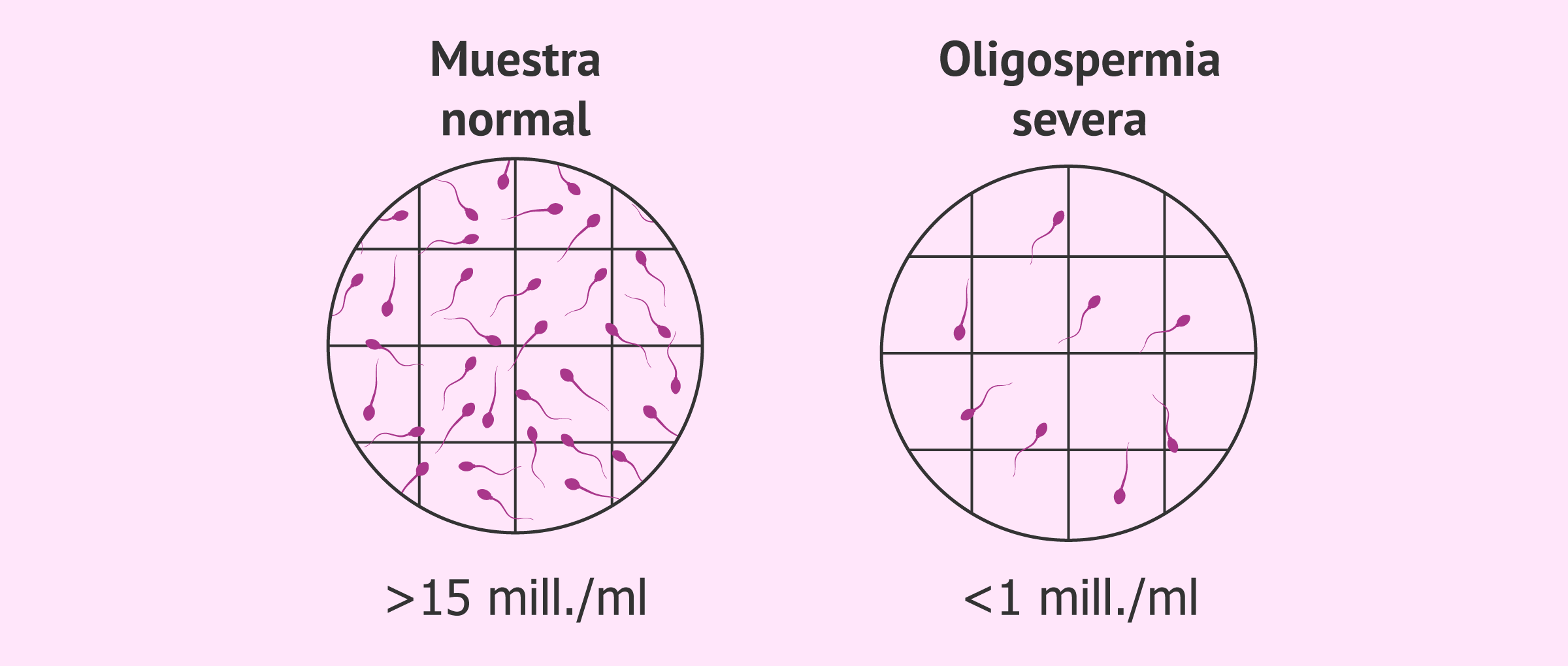 La oligospermia severa