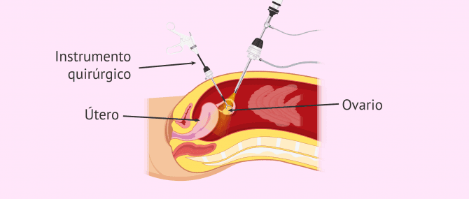 Qué es la ooforectomía?