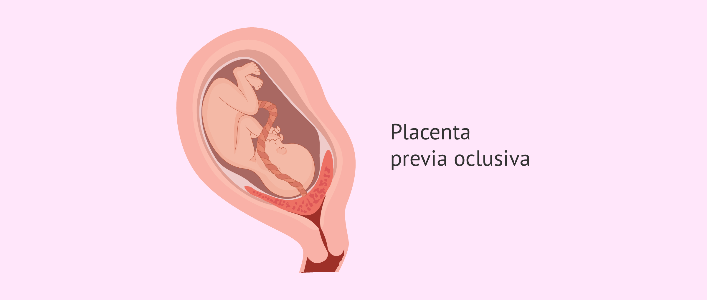 Placenta previa oclusiva o total