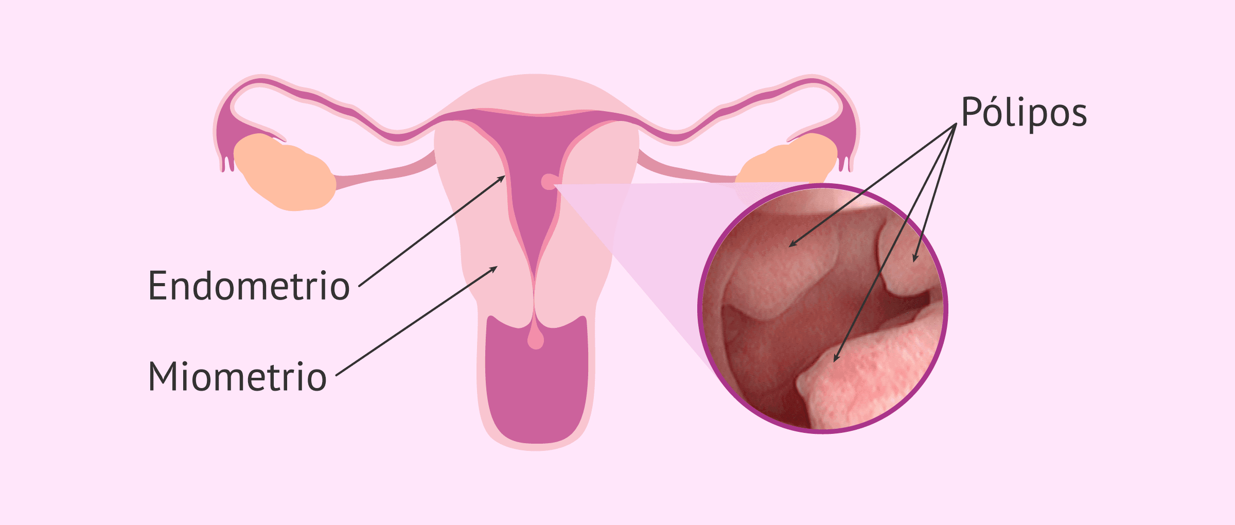 Imagen: Pólipos endometriales y esterilidad
