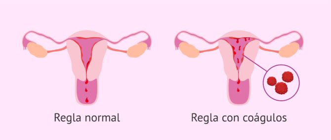 Por qué coágulos de sangre menstruación?