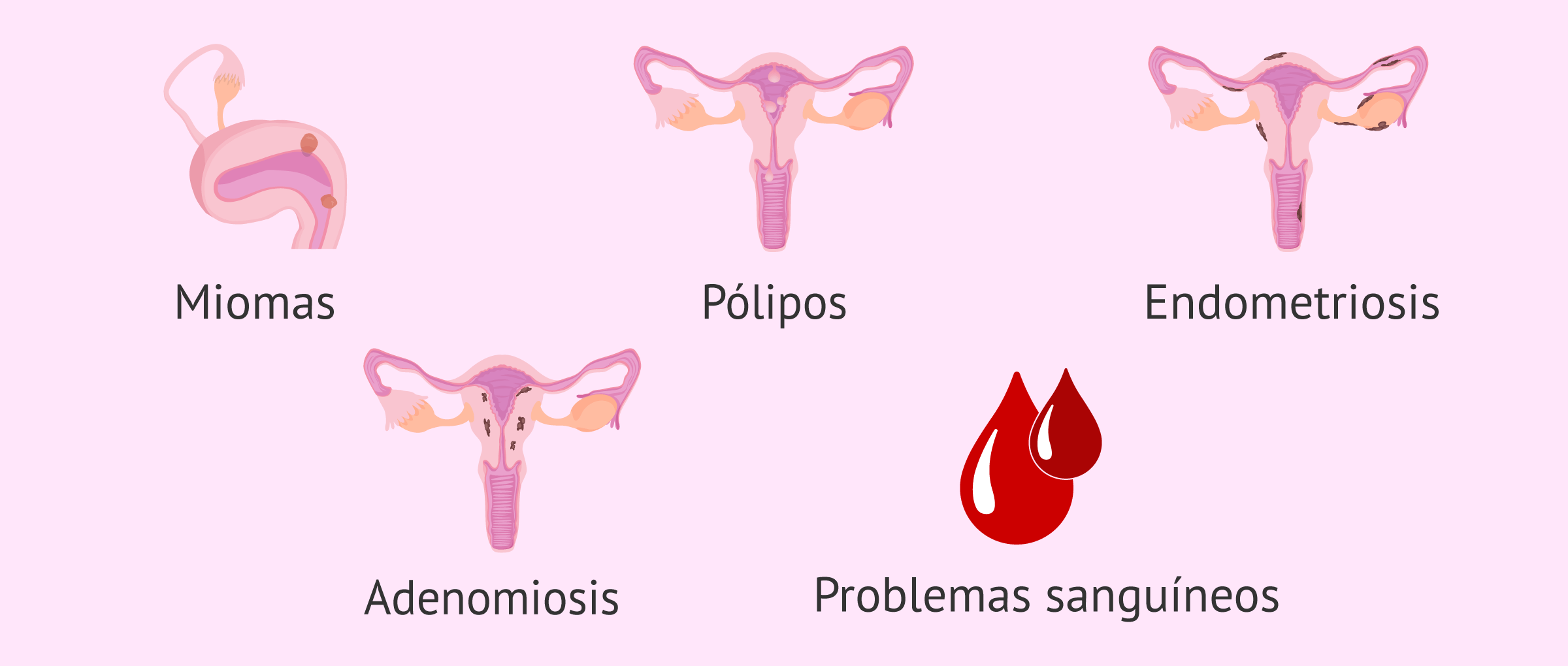 Posibles patologías tras los coágulos menstruales