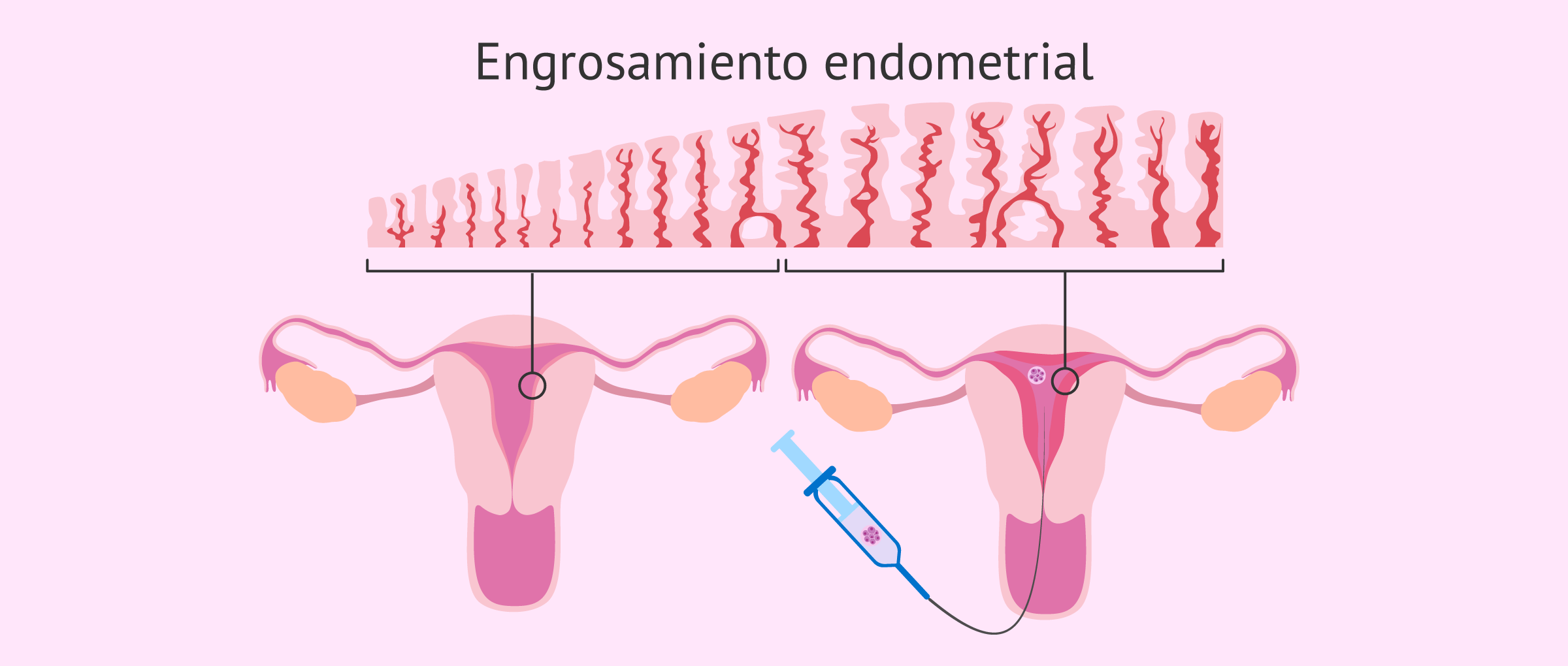 Preparación endometrial para la transferencia embrionaria