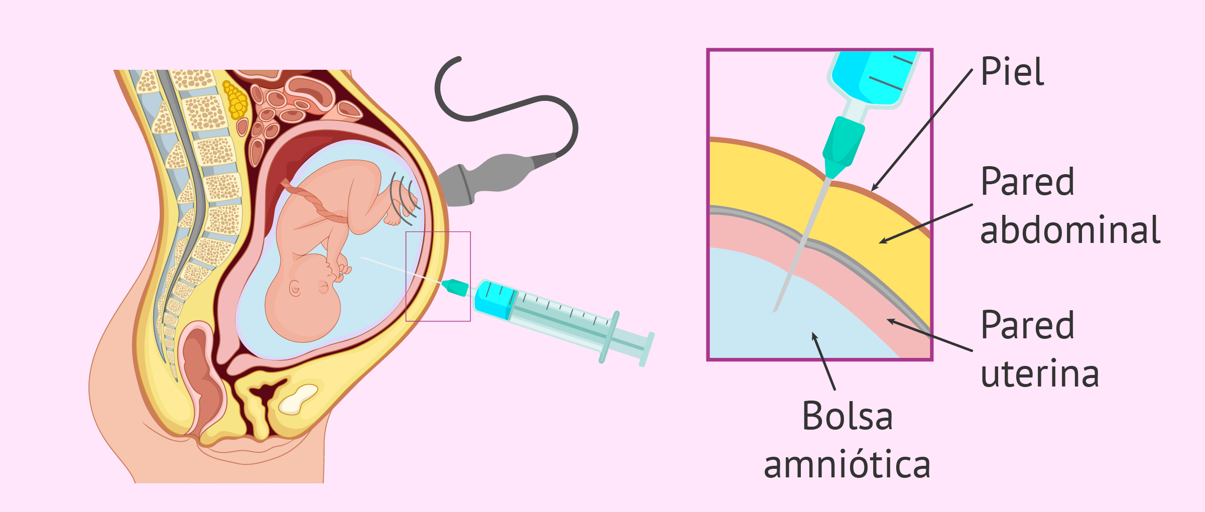 ¿Cómo es el procedimiento de la amniocentesis?