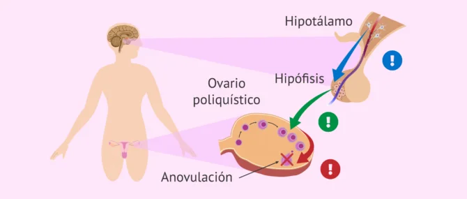 Imagen: ¿Qué es el síndrome de ovarios poliquísticos (SOP)?