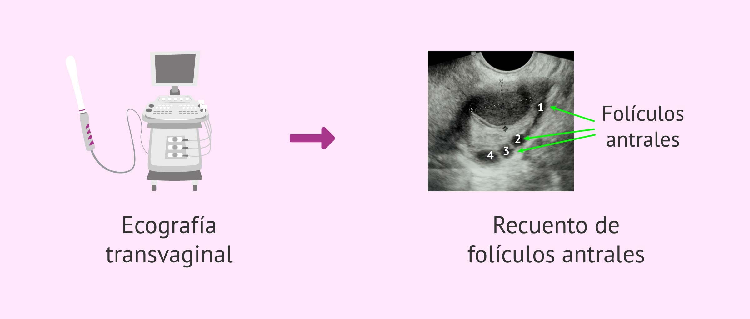 Imagen: Ecografía transvaginal para el recuento de folículos