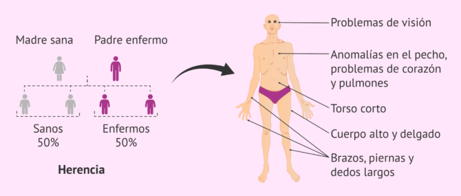 Imagen: Herencia y síntomas del Síndrome de Marfan
