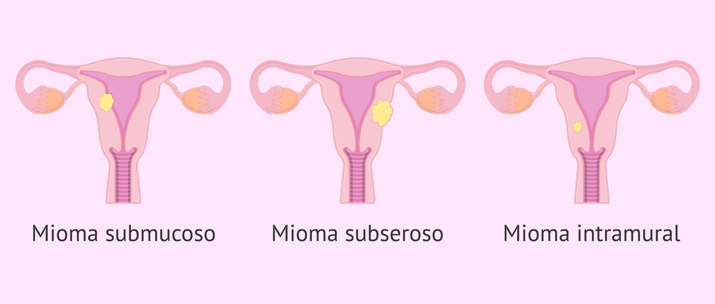 tipos-de-miomas-uterinos-II