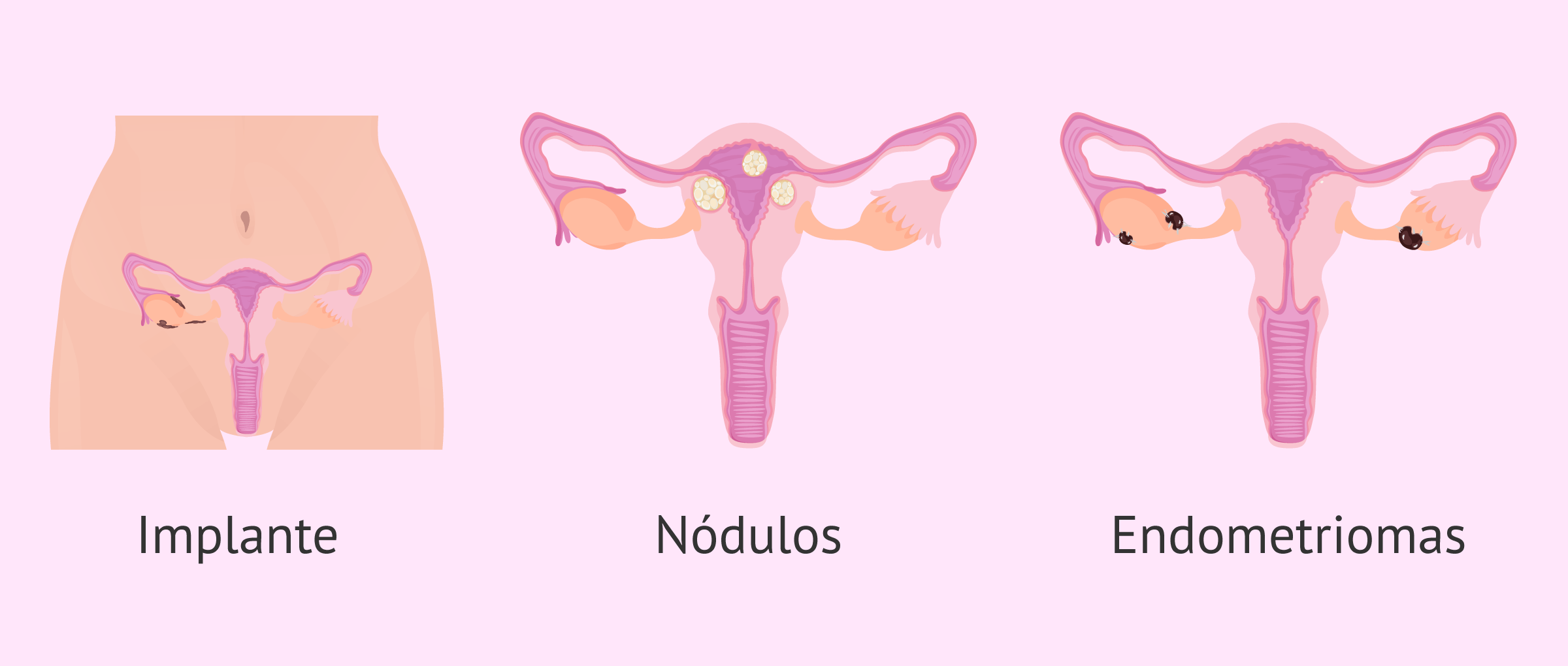 Placas endometriales según la gravedad