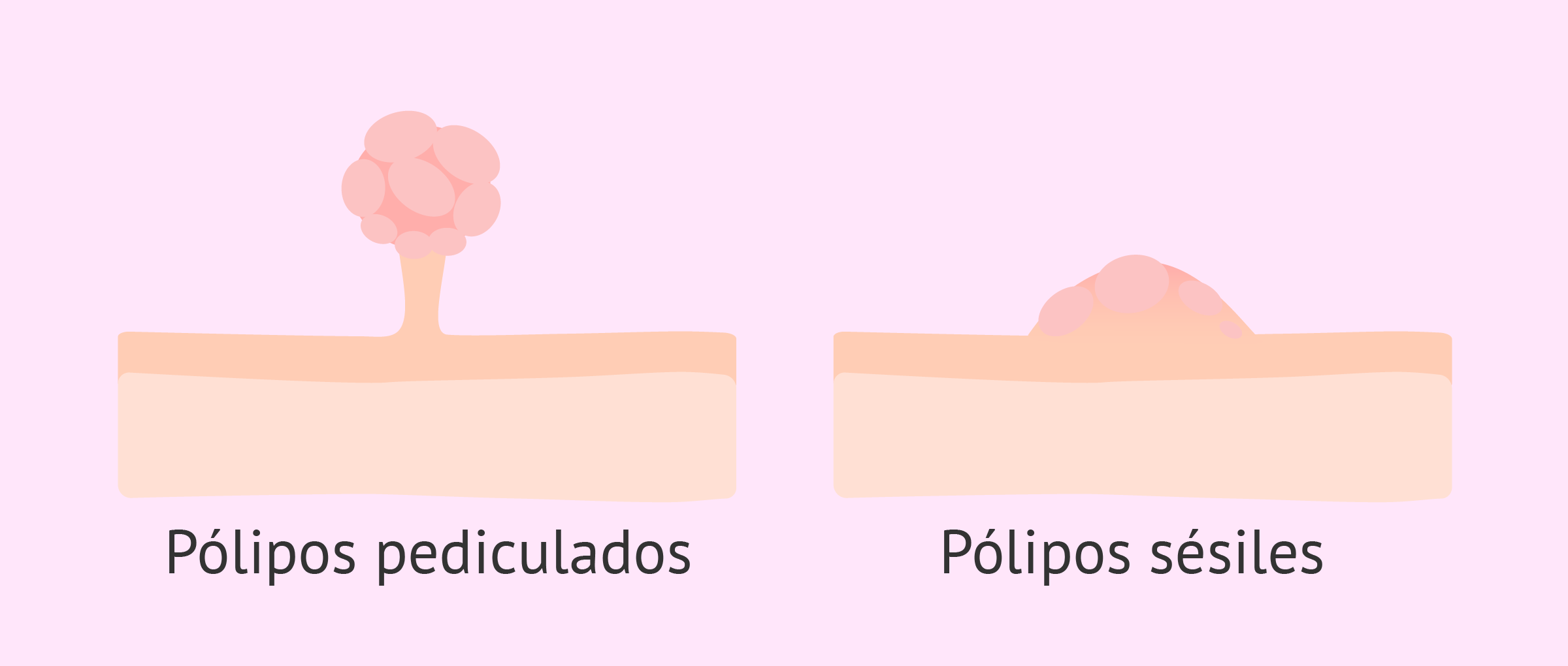 Tipos de pólipos uterinos: sésiles y pediculados