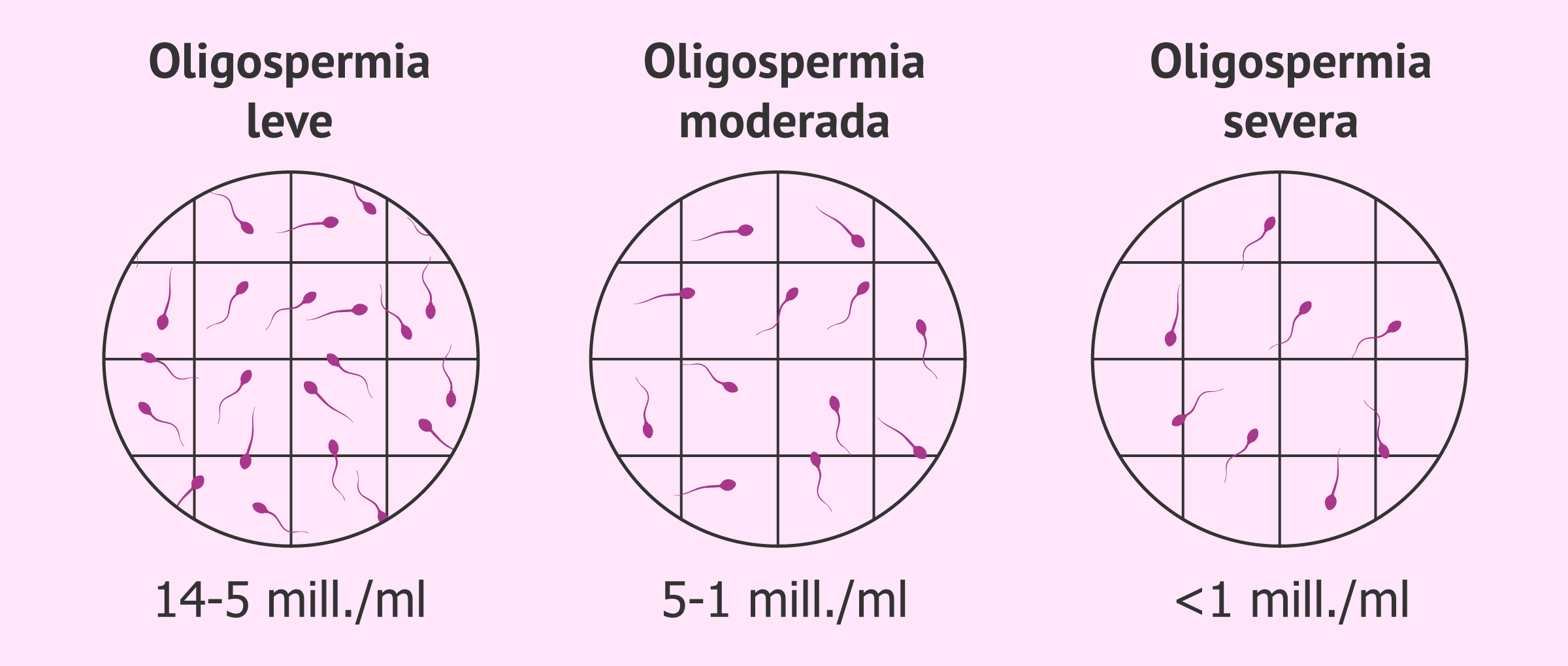 Tipos de oligospermia