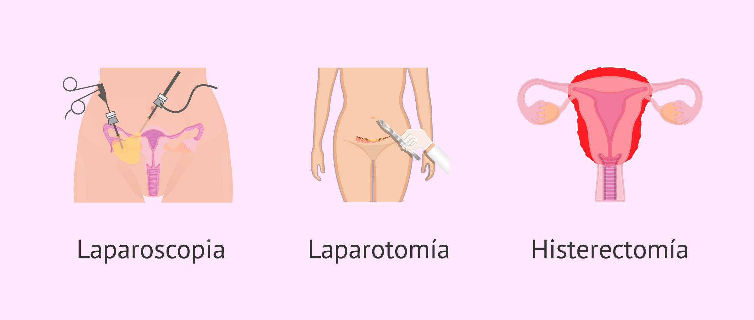 Opciones quirúrgicas para la endometriosis