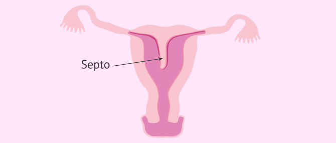 Imagen: Utero-septado-definicion