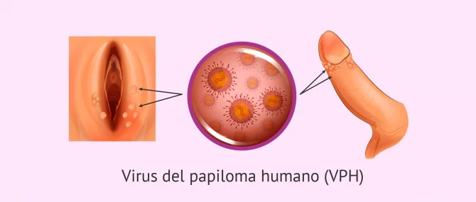 Imagen: Verrugas genitales por VPH