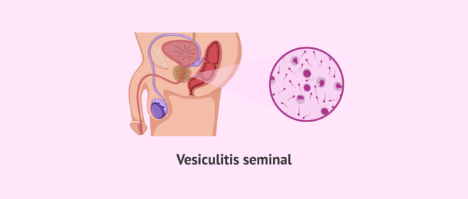 Imagen: Vesiculitis