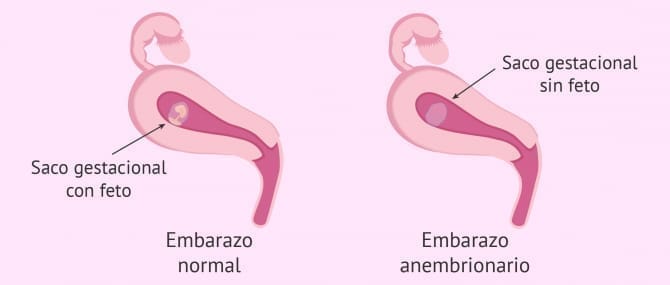 ¿Qué es el embarazo anembrionario? - Detección y tratamiento