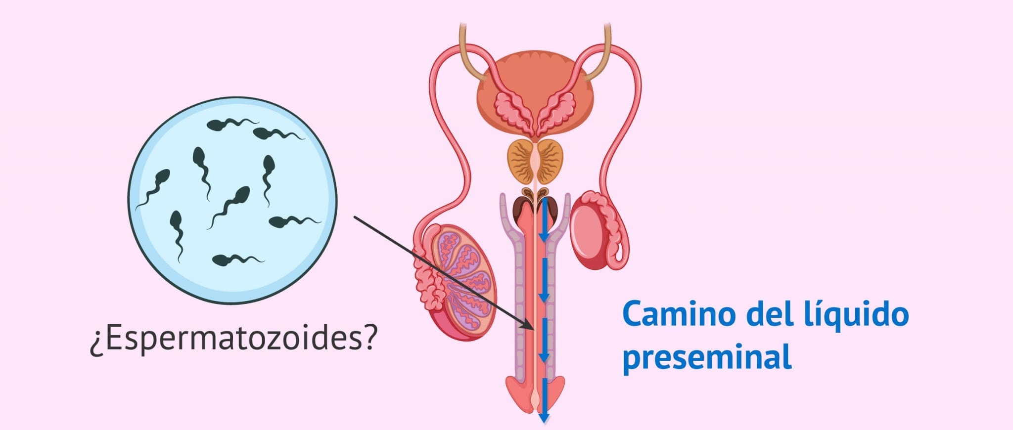Espermatozoides en líquido preseminal: ¿hay probabilidad de embarazo?