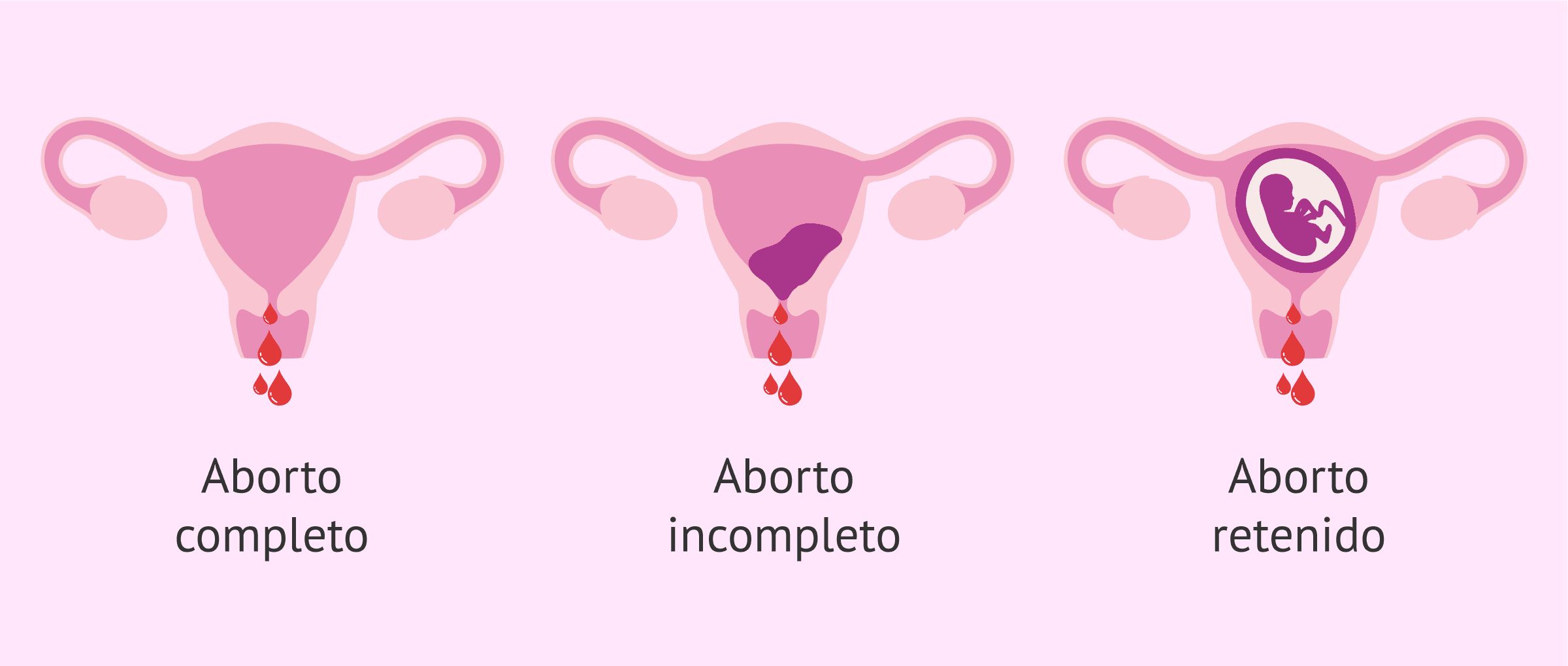 Tipos de aborto según la variedad clínica