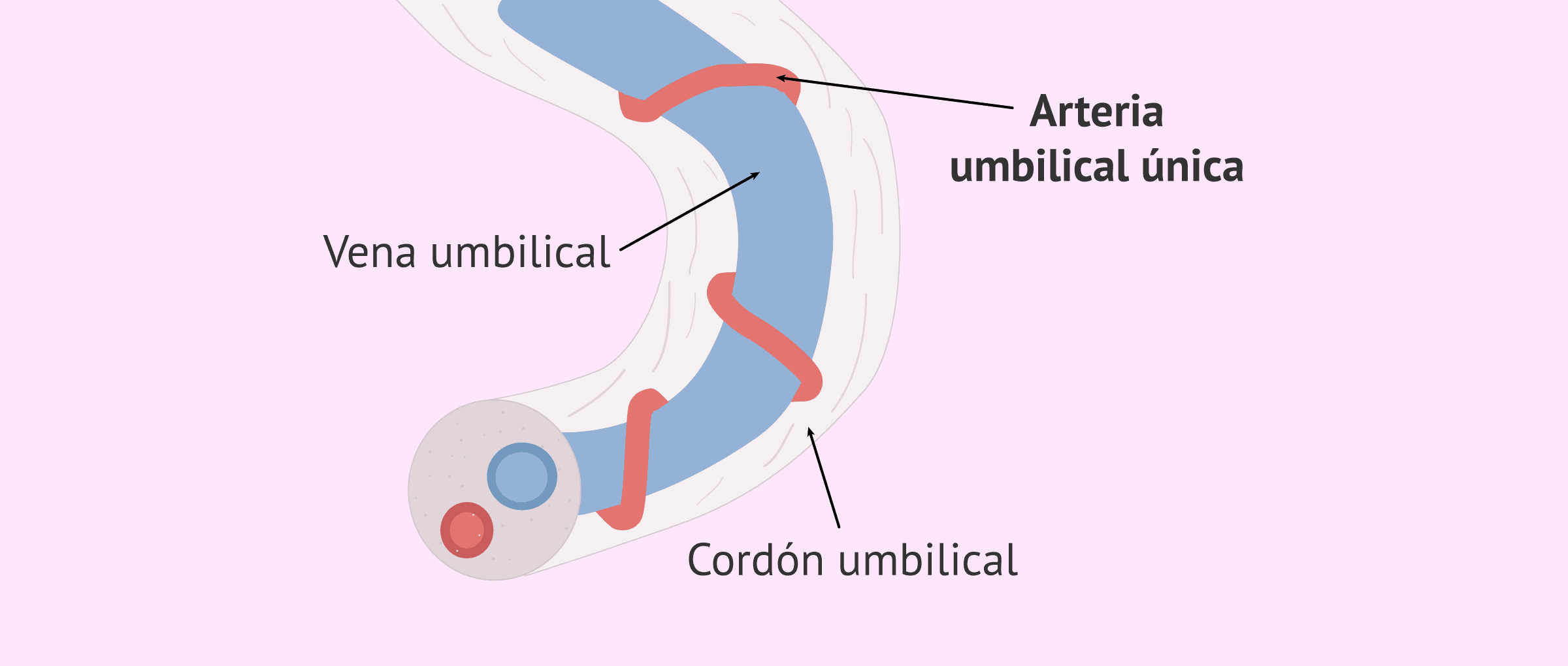 Anomalías del cordón umbilical: arteria umbilical única