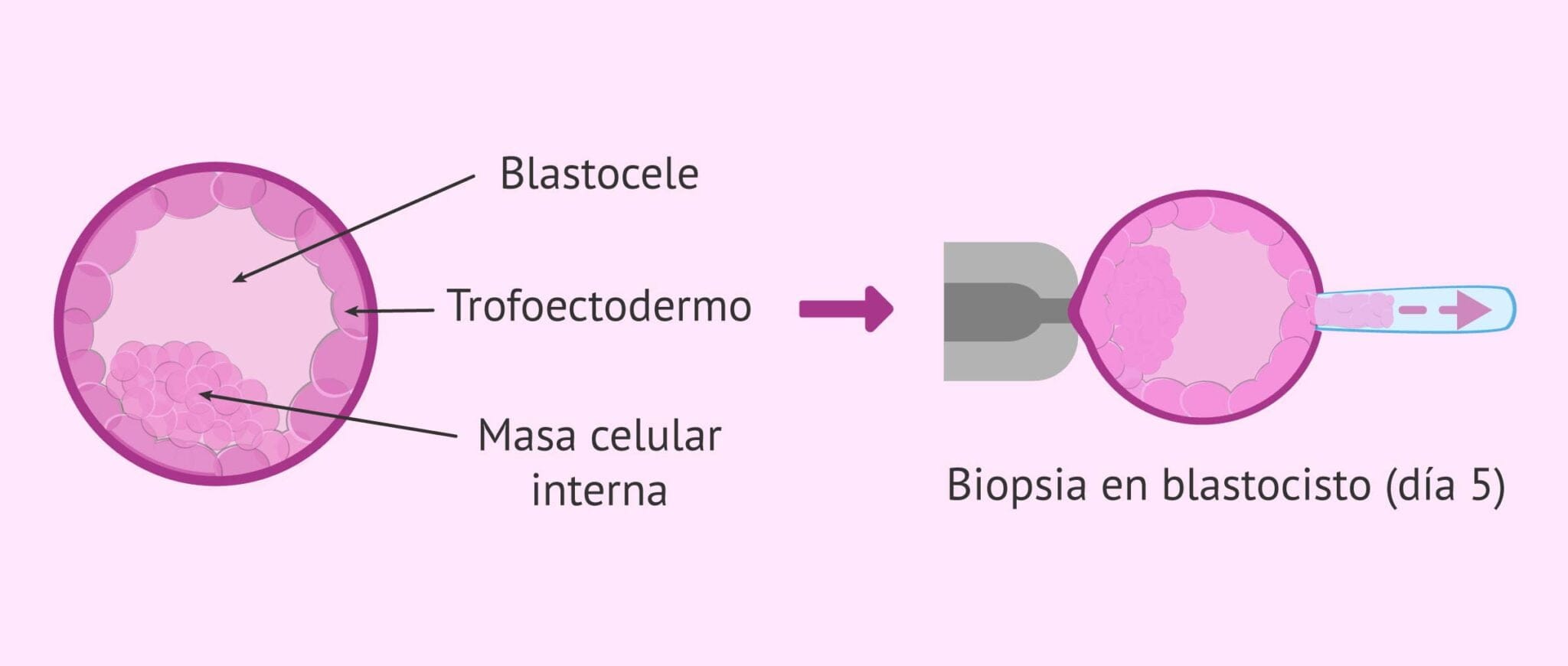 ¿Es posible la biopsia para el DGP en embriones que han sido ...