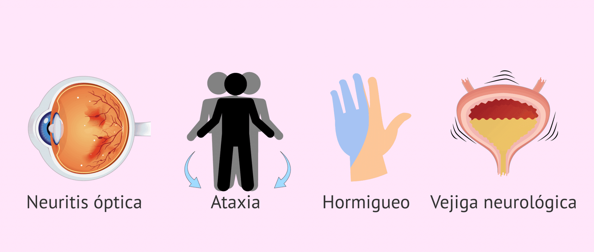 Síntomas de la esclerosis múltiple (EM)