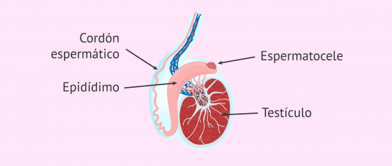 ¿Qué es un espermatocele?