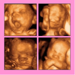 Un algoritmo matemático acompañado de las ecografías ayudará a decidir el momento óptimo para el parto en fetos con problemas de desarrollo