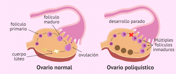 Síndrome del ovario poliquístico (SOP): causas, síntomas y tratamiento