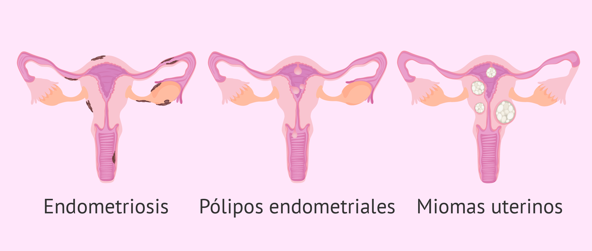 Qué es el endometrio