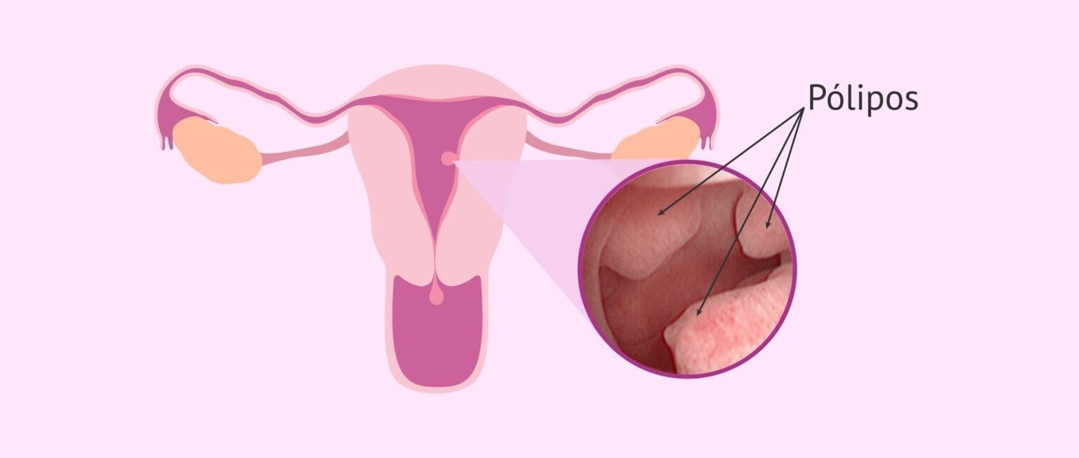Los pólipos uterinos malignos: tipos, síntomas y tratamientos