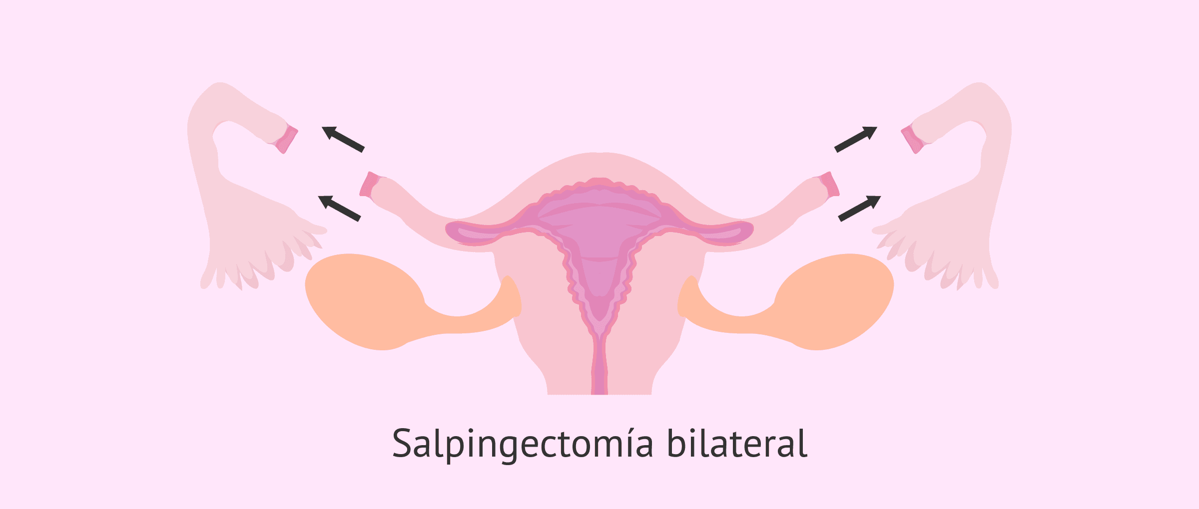 Salpingectomía bilateral