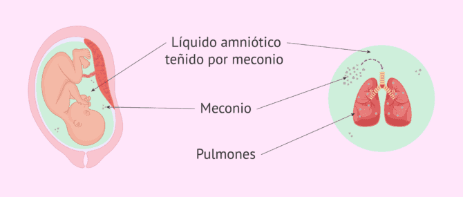 ¿Qué es y cuándo se produce el síndrome de aspiración de meconio?