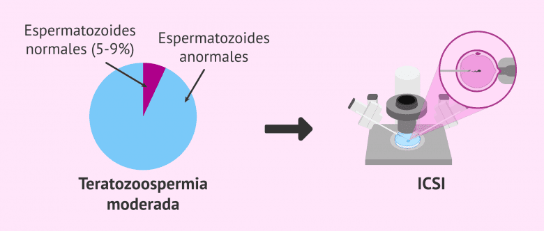 Tipos de teratozoospermia: leve, moderada y severa