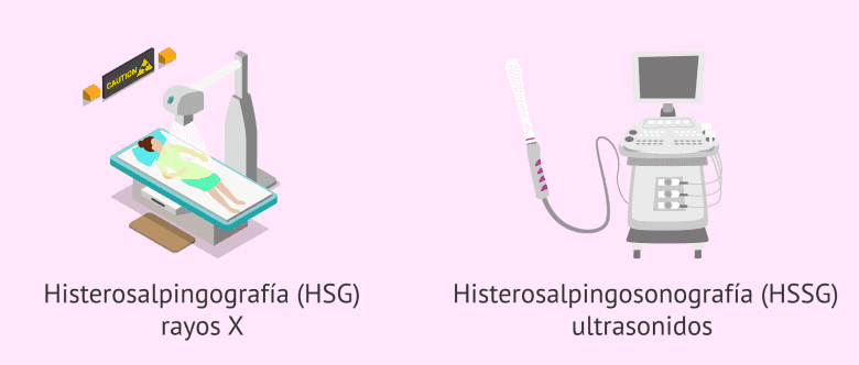 ¿Qué es la histerosalpingografía? - Indicaciones y resultados