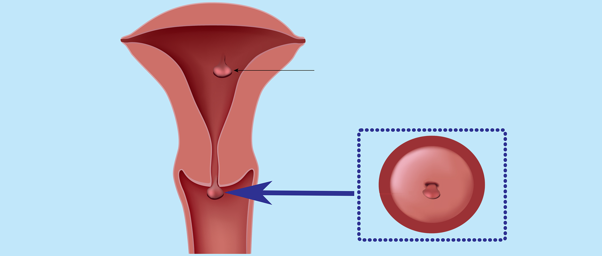 ¿Qué es un pólipo endometrial o uterino? - Síntomas y tratamiento