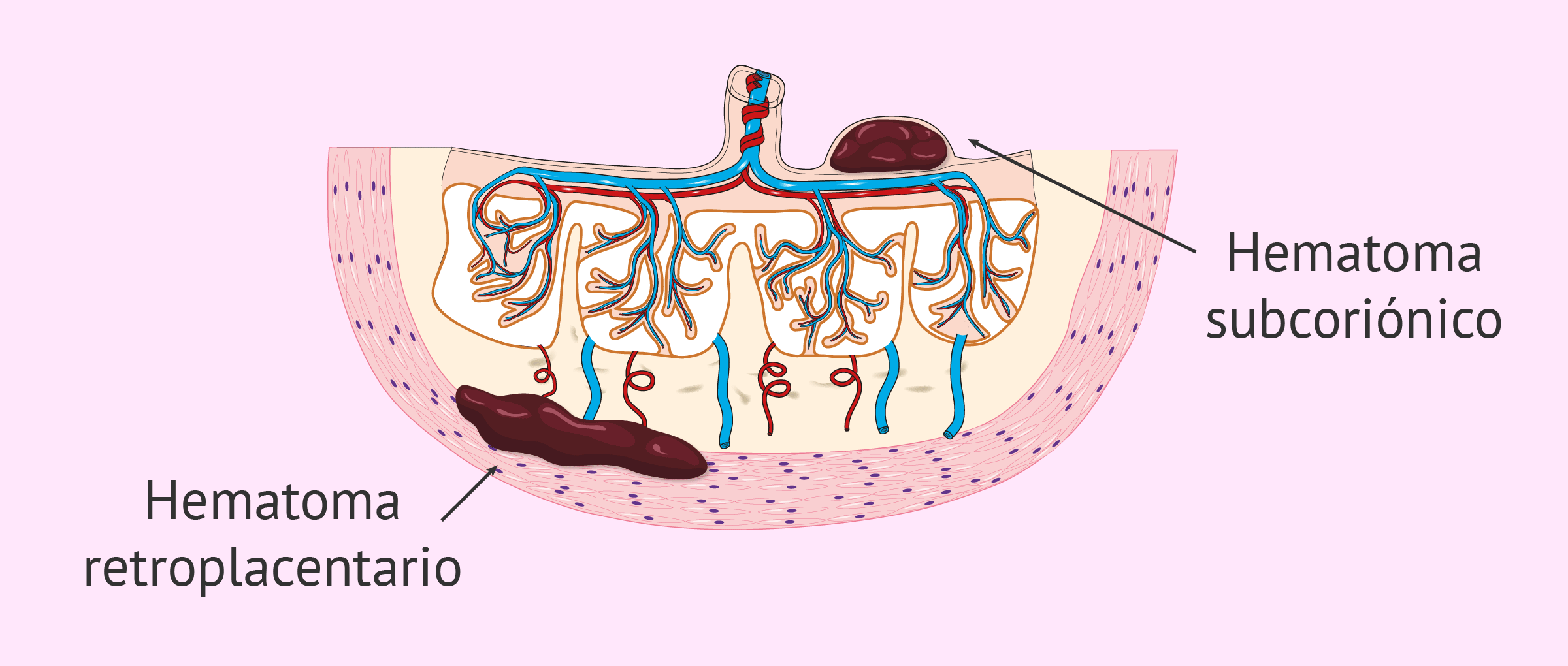 Hematomas intrauterinos en el embarazo: causas y tratamiento