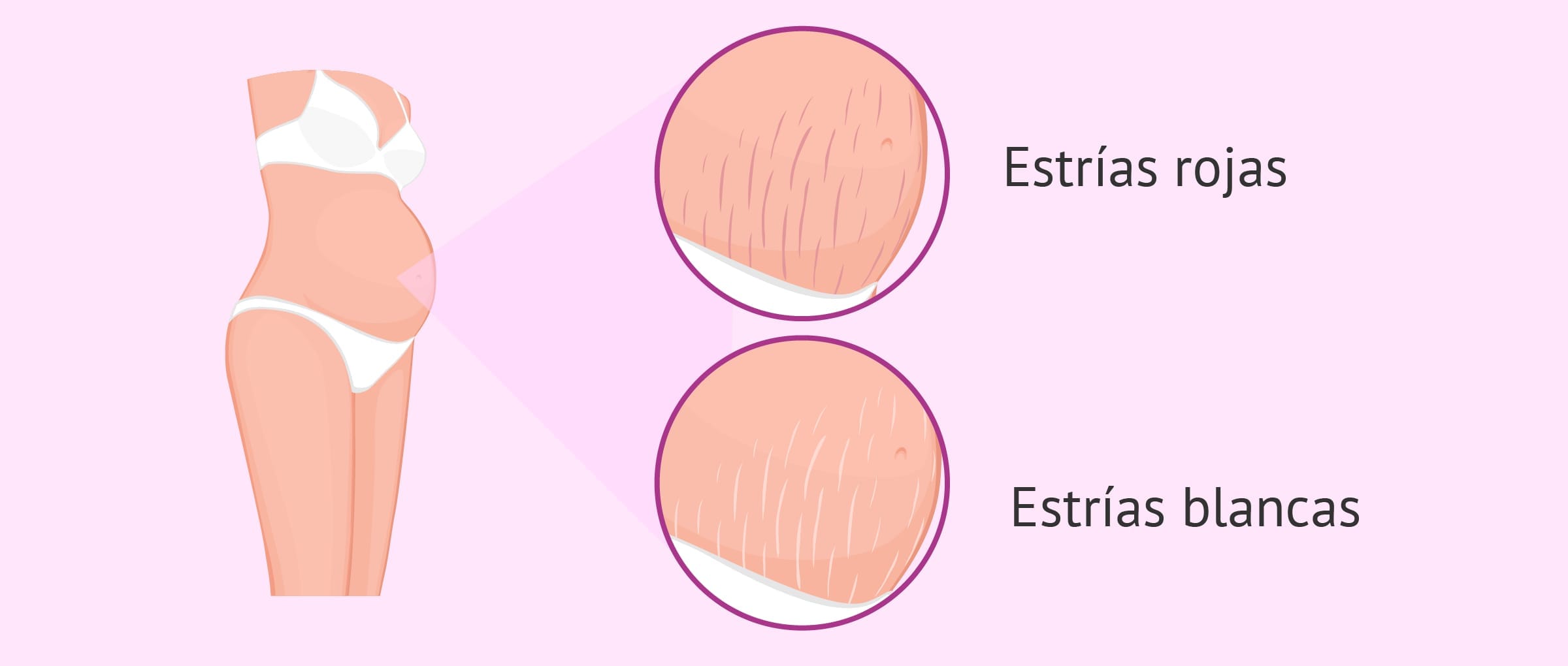 Estrías en el embarazo