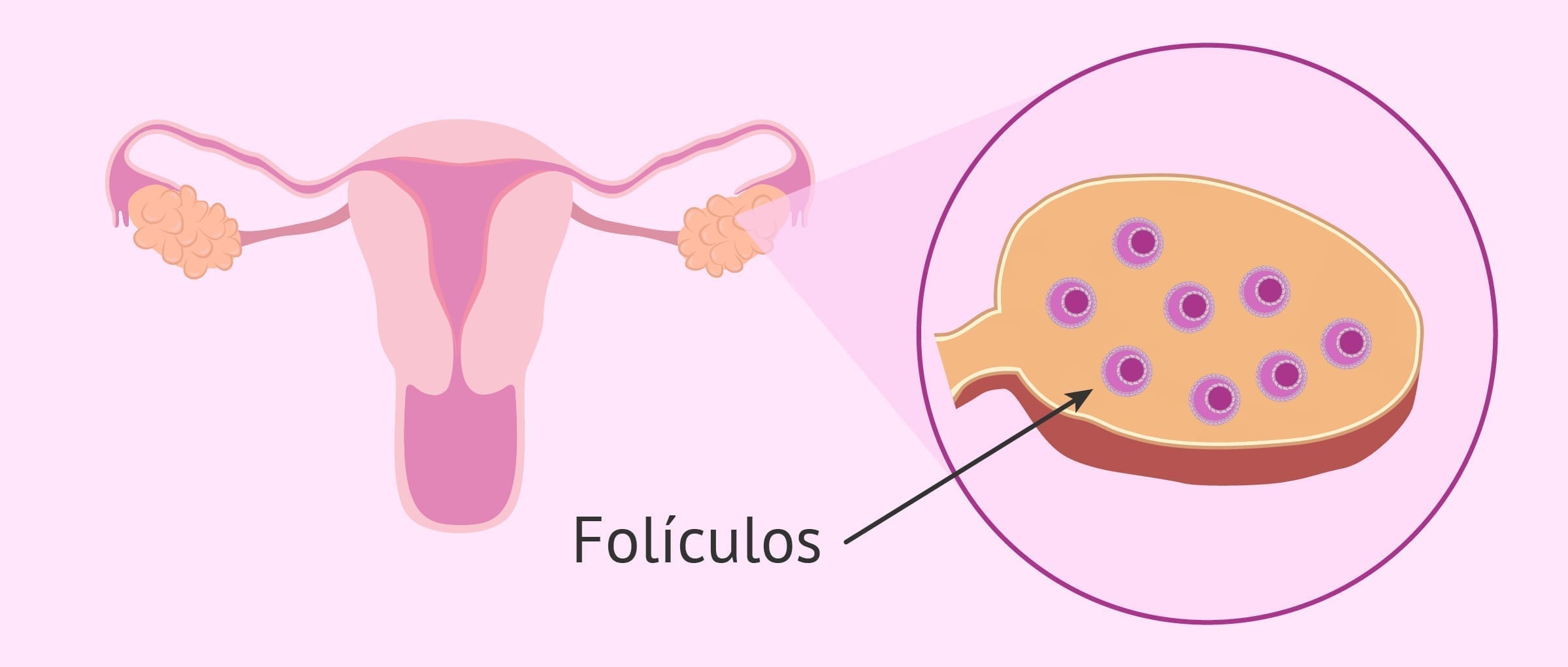 ¿Cuál es la diferencias entre ovario poliquístico y SOP?