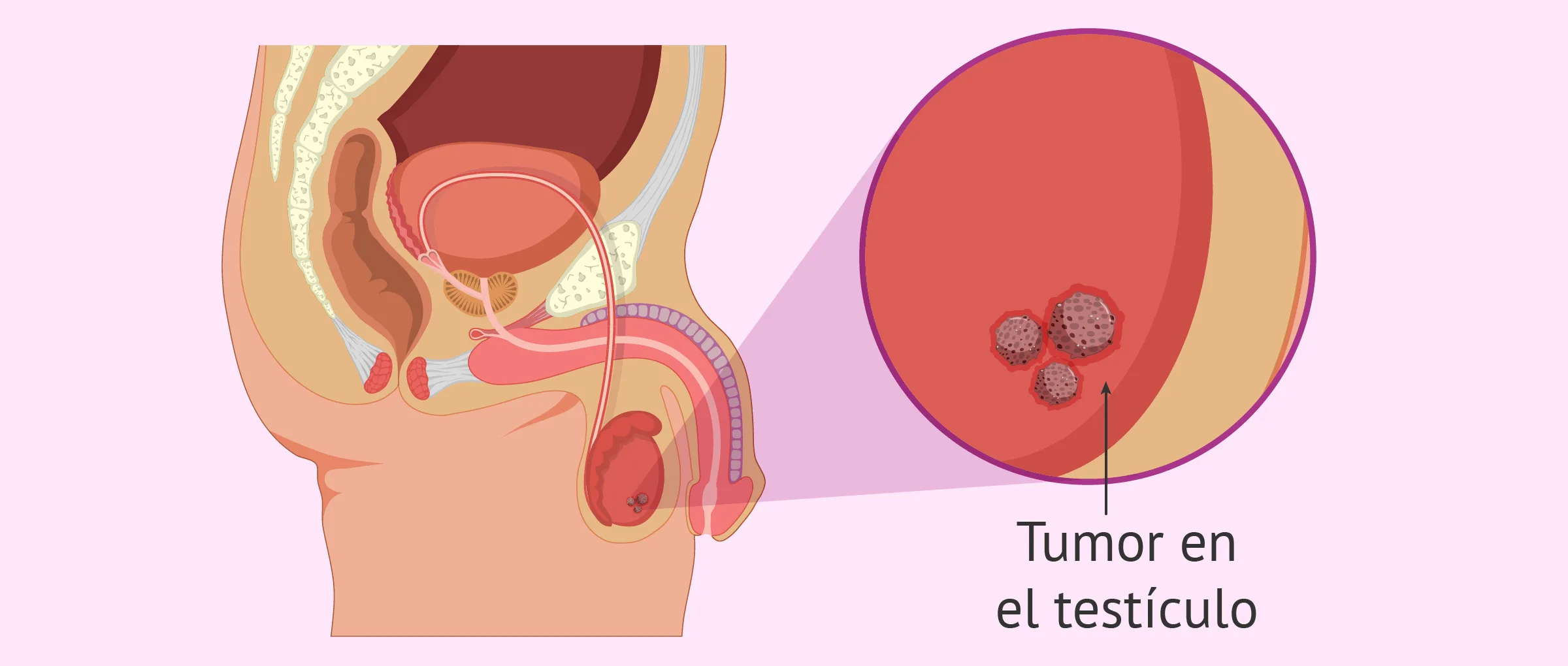 El cáncer testicular