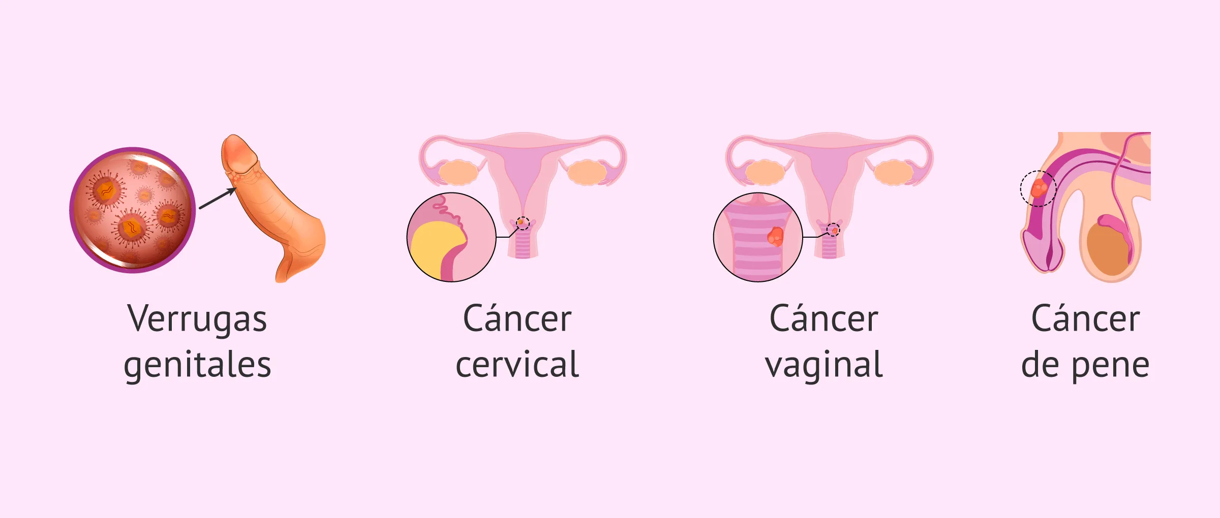 Consecuencias del virus del papiloma humano