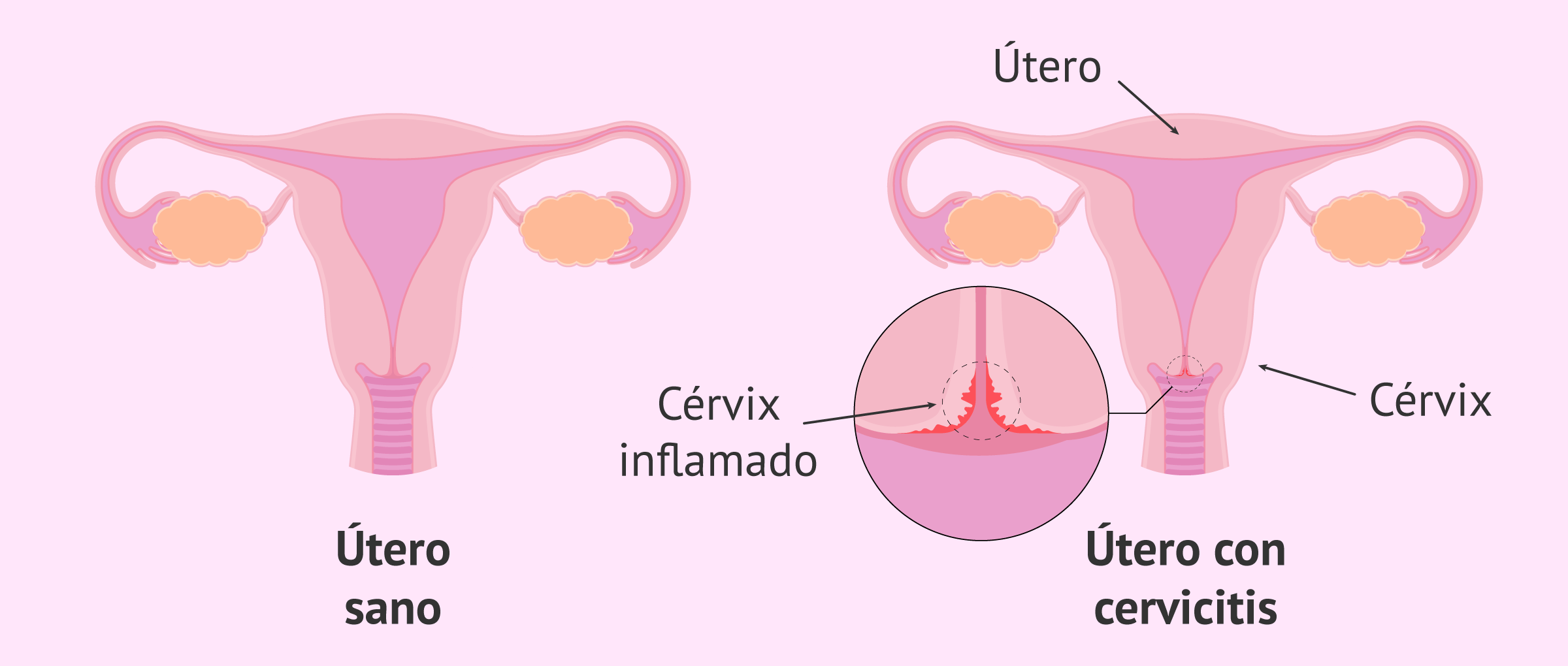 La cervicitis
