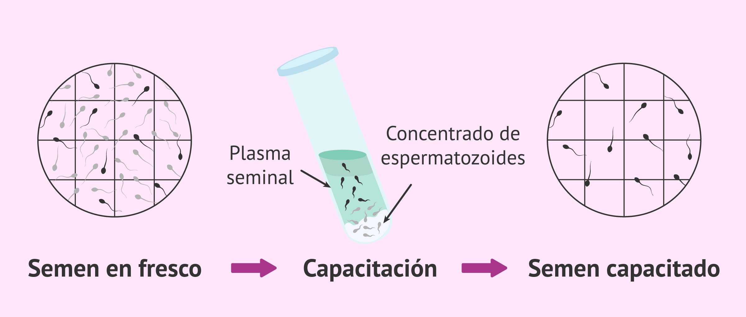 Seminograma con recuento de espermatozoides móviles (REM)