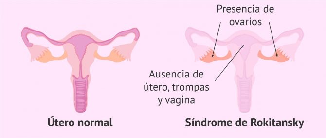 Imagen: Agenesia vaginal: ausencia de útero