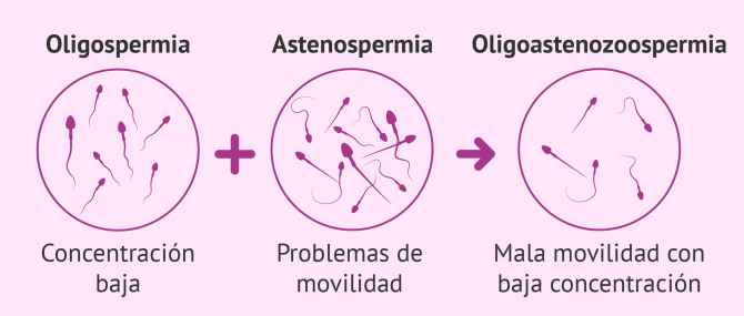 Imagen: Cómo se diagnostica la oligoastenospermia